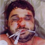 This pictures shows the severe beating suffered by Iraqi civilian Baha Mousa who died in UK custody. The inquiry heard he had 93 separate external injuries.