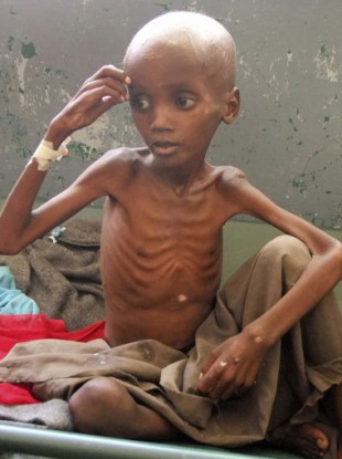 A severely malnourished child in southern Somalia.