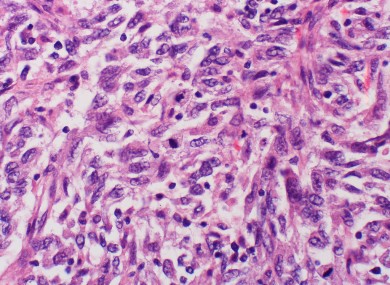 Ipilimumab - marked as Yervoy by its makers - is thought to be the most effective drug yet in the treatment of melanoma (pictured).
