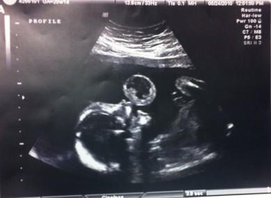 A 17-week ultrasound showed this 'bubble' - a tumour - growing from Leyna Gonzalez's lip.